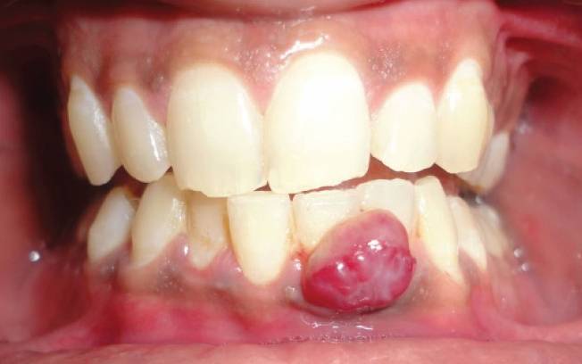 Granulom dentar
