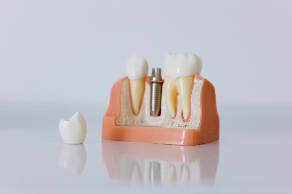 punte dentara implant