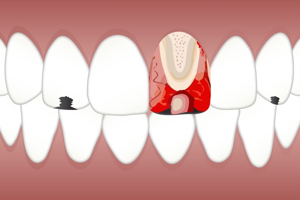 gangrena dentara