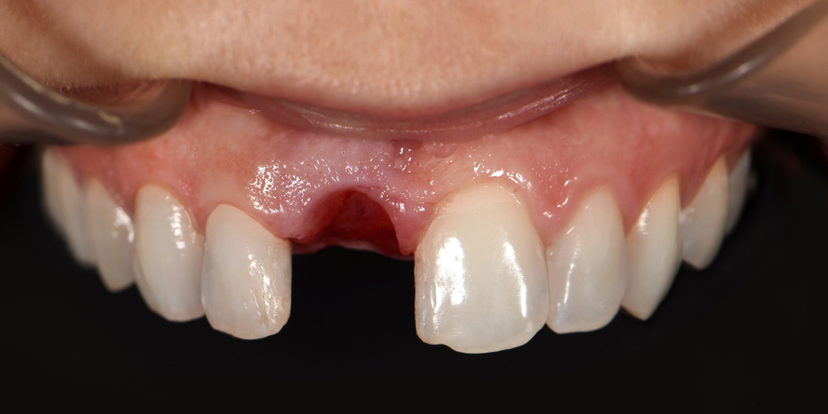 implant dentar inainte