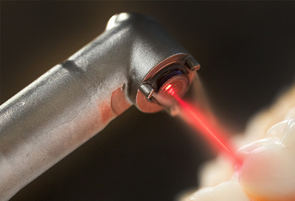 Parodontoza tratament stomatologic cu laser