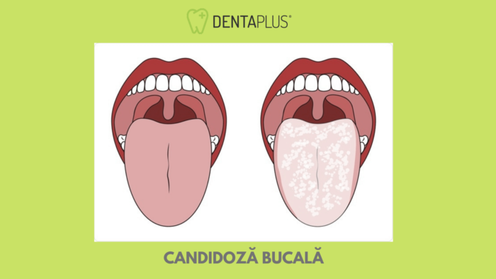 Candidoza Bucala (Orala): Tratament, Cauze, Simptome | Newwp ...